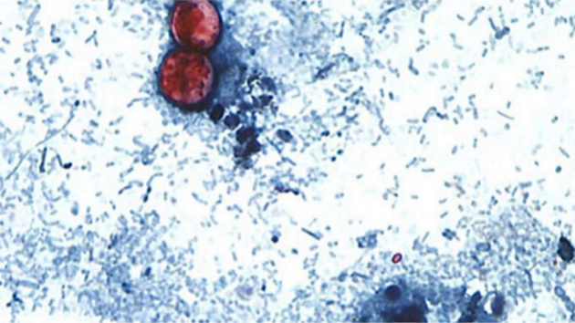 Federal health officials have investigated 5 different clusters of cyclosporiasis cases, FDA says