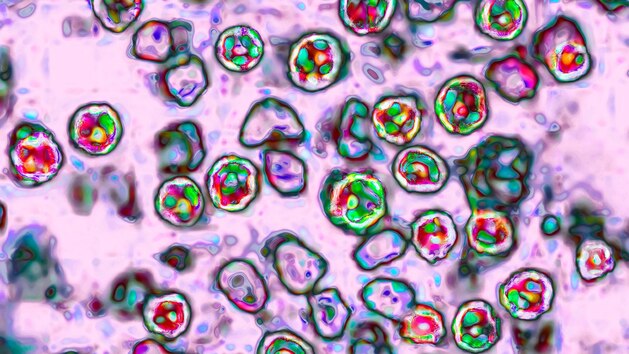 Pennsylvania surpasses 900 measles cases with 13 new confirmed infections: Officials